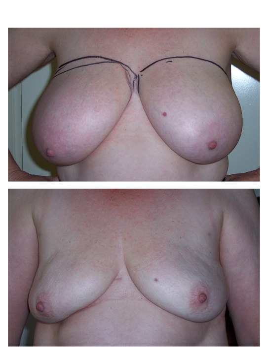 Liposuction of large breasts